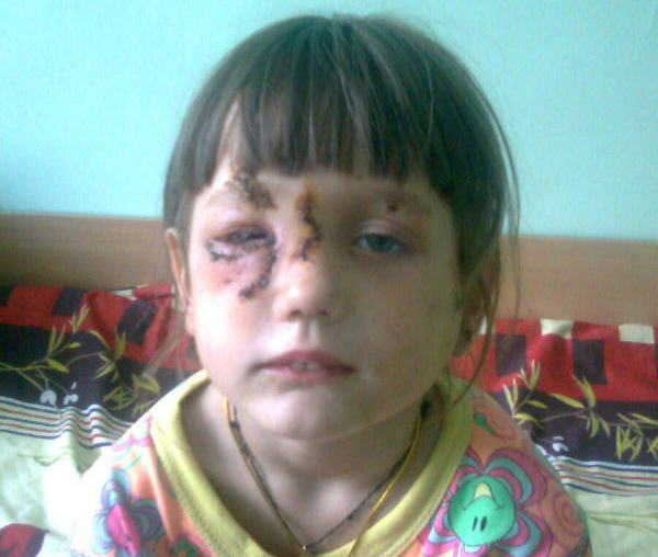 6-летняя Маша пострадала от собаки